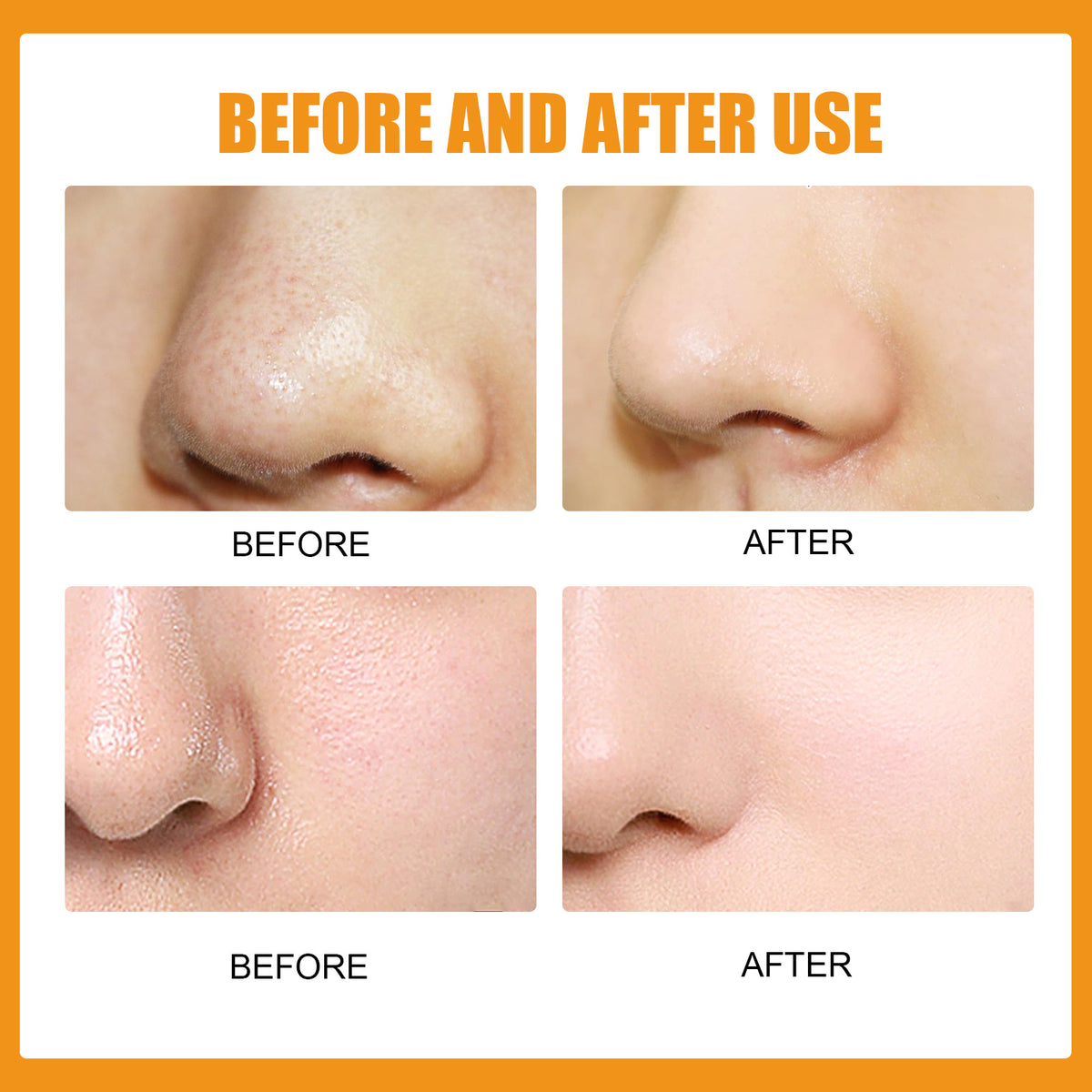 Peel-Off Pore Sticks